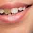 علت و دلایل سیاه شدن دندان‌ ها
